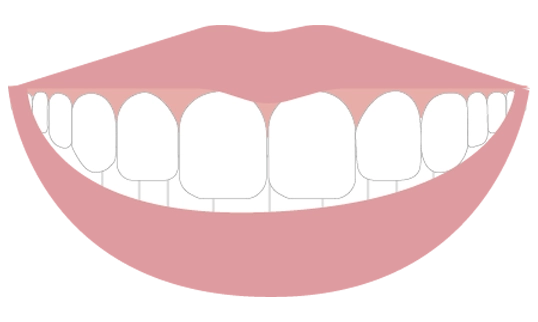 前歯の先端を結んだ曲線